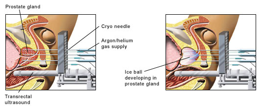 Diagrams illustrating the cryotherapy procedure