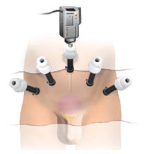 Diagram illustrating the laproscopic radical prostatectomy technique