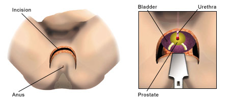 Diagrams illustrating the perineal radical prostatectomy technique