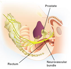Diagram illustrating the position of the prostate with regards to the neurovasclar bundle that controls erections