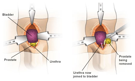 Diagram illustrating the retropubic radical prostatectomy technique